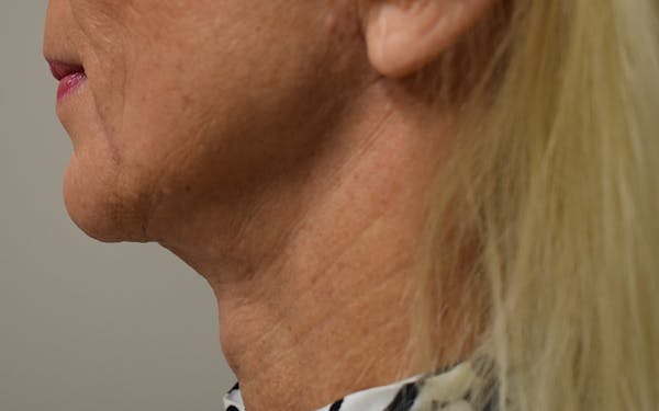 Facelift Before & After Gallery - Patient 306919 - Image 2