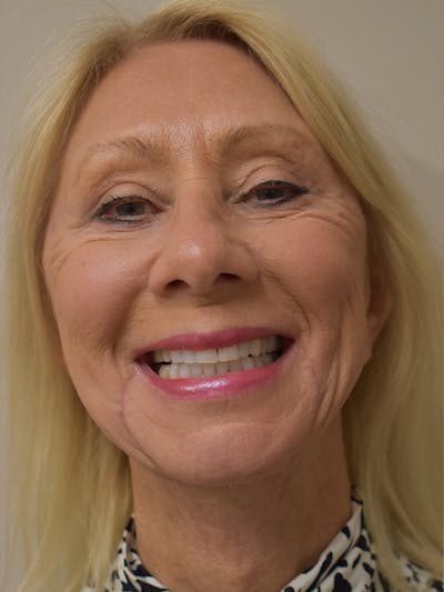 Facelift Before & After Gallery - Patient 306919 - Image 4