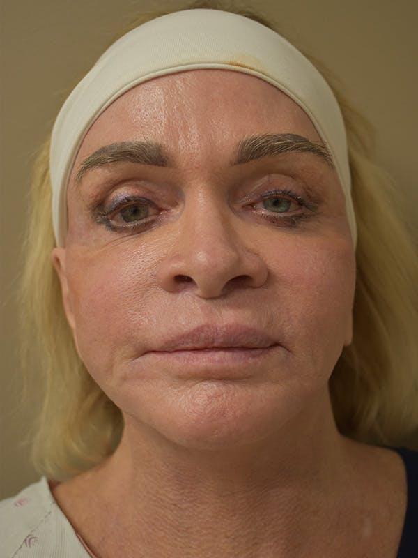 Lip Lift Before & After Gallery - Patient 349722 - Image 1