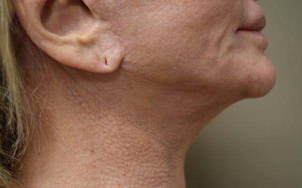 Facelift Before & After Gallery - Patient 427917 - Image 3