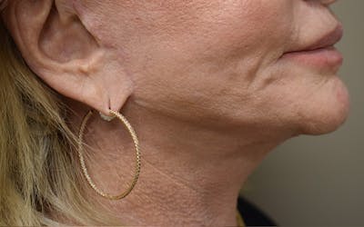 Facelift Before & After Gallery - Patient 427917 - Image 4