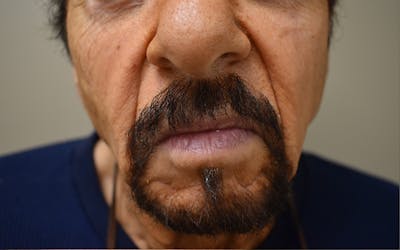 Nasolabial Fold Before & After Gallery - Patient 590126 - Image 1
