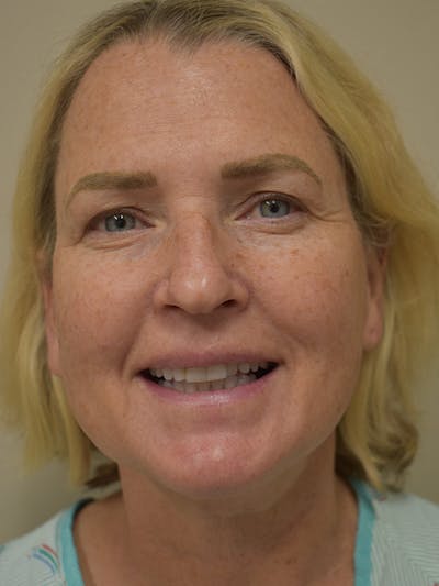 Cheek Lift Before & After Gallery - Patient 411700 - Image 1