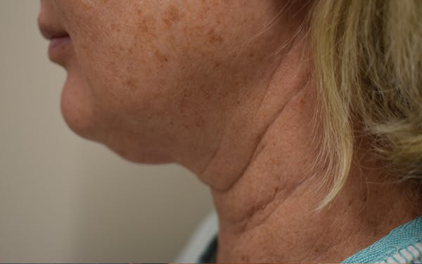 Cheek Lift Before & After Gallery - Patient 411700 - Image 3