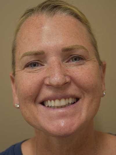 Cheek Lift Before & After Gallery - Patient 411700 - Image 2