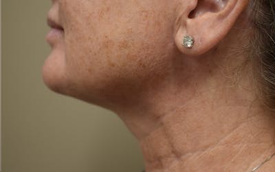 Cheek Lift Before & After Gallery - Patient 411700 - Image 4