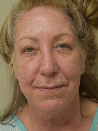 Facelift Before & After Gallery - Patient 396266 - Image 1