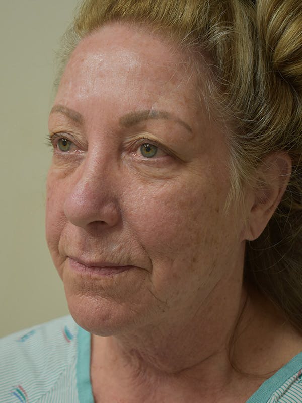 Facelift Before & After Gallery - Patient 396266 - Image 3