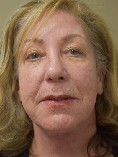 Facelift Before & After Gallery - Patient 396266 - Image 2