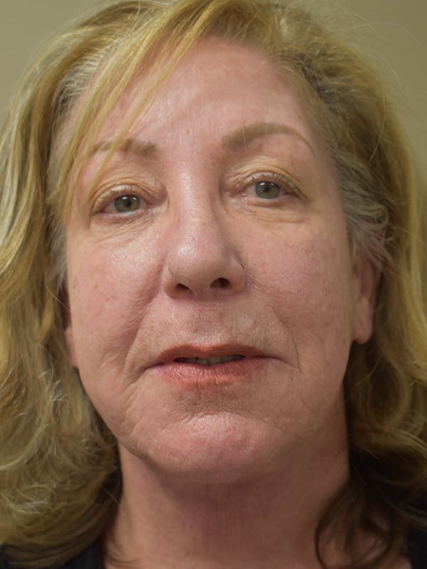 Facelift Before & After Gallery - Patient 396266 - Image 2