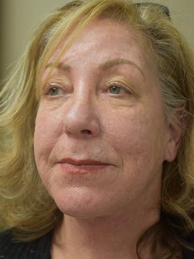 Facelift Before & After Gallery - Patient 396266 - Image 4