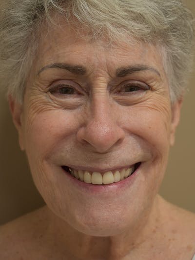 Co2 Laser Resurfacing Before & After Gallery - Patient 340523 - Image 1