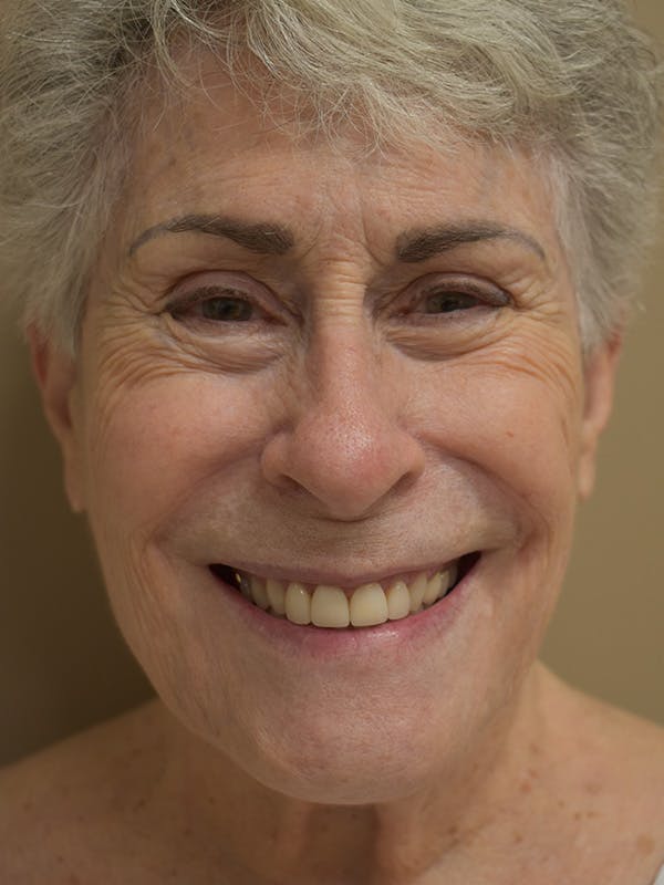 Co2 Laser Resurfacing Before & After Gallery - Patient 340523 - Image 1