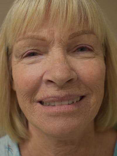 Co2 Laser Resurfacing Before & After Gallery - Patient 319036 - Image 1