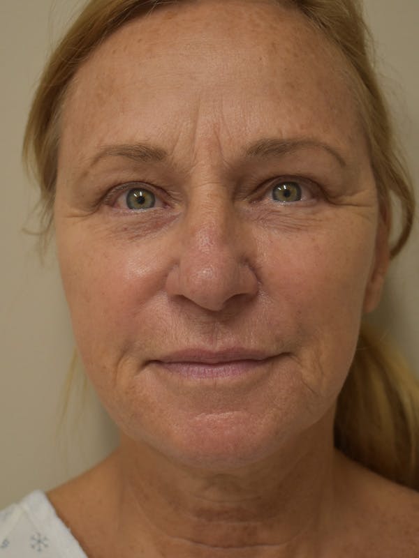 Cheek Lift Before & After Gallery - Patient 225019 - Image 1