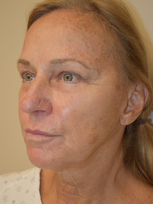 Cheek Lift Before & After Gallery - Patient 225019 - Image 3