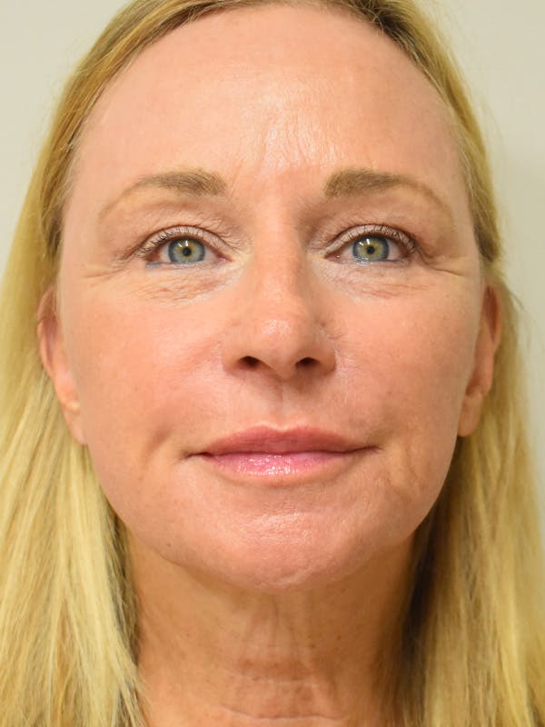Co2 Laser Resurfacing Before & After Gallery - Patient 367546 - Image 2
