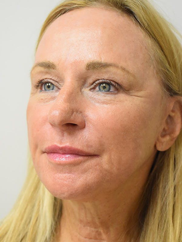 Cheek Lift Before & After Gallery - Patient 225019 - Image 4