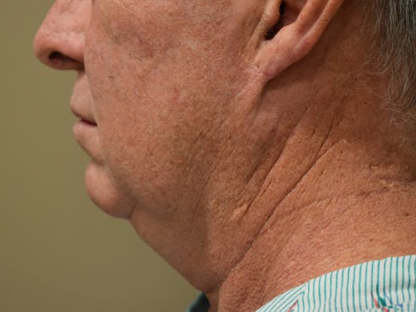 Facelift Before & After Gallery - Patient 327087 - Image 3