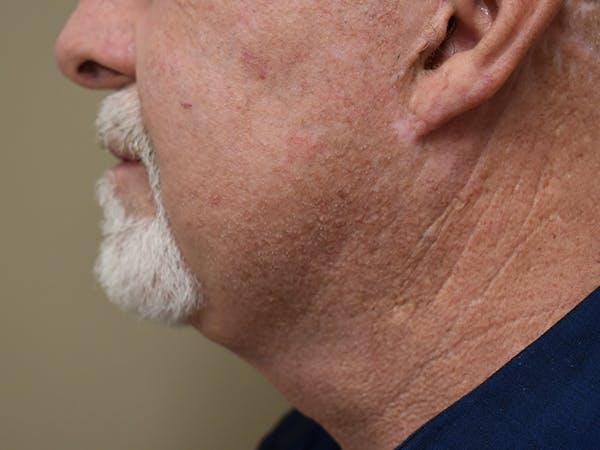Facelift Before & After Gallery - Patient 327087 - Image 4
