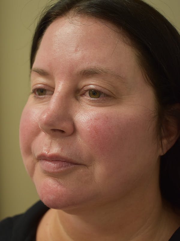 Chin Augmentation Before & After Gallery - Patient 546282 - Image 1