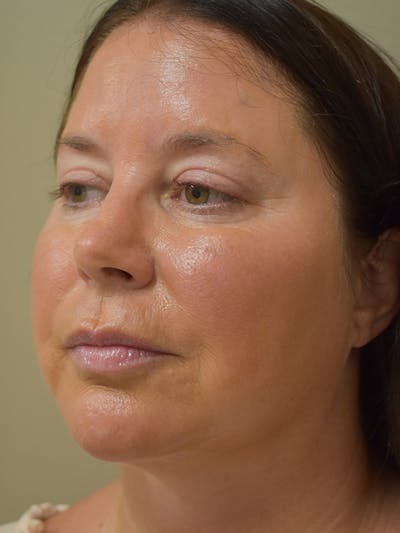 Chin Augmentation Before & After Gallery - Patient 546282 - Image 2