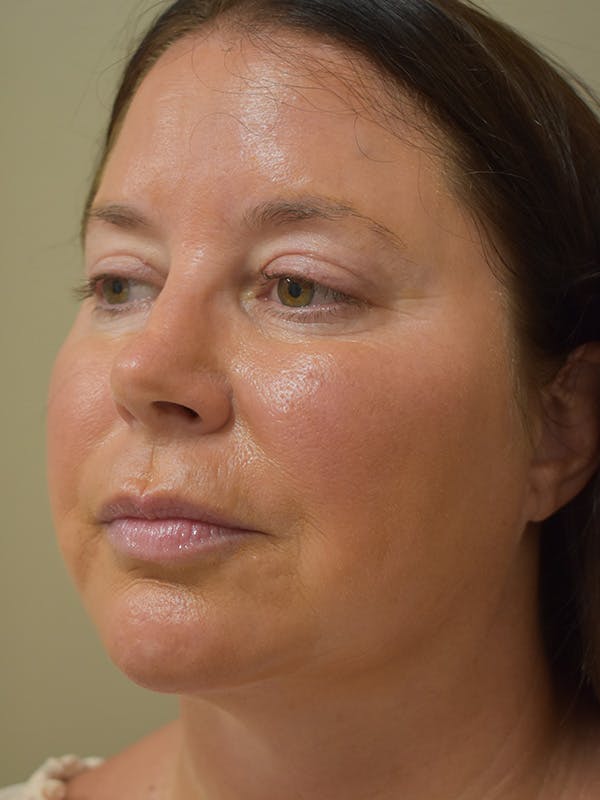 Chin Augmentation Before & After Gallery - Patient 546282 - Image 2