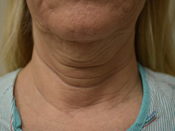 Facelift Before & After Gallery - Patient 342566 - Image 1