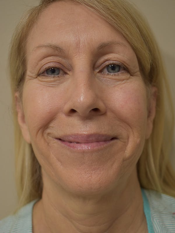 Facelift Before & After Gallery - Patient 342566 - Image 3