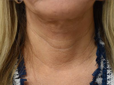 Facelift Before & After Gallery - Patient 342566 - Image 2