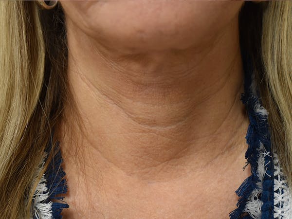 Facelift Before & After Gallery - Patient 342566 - Image 2