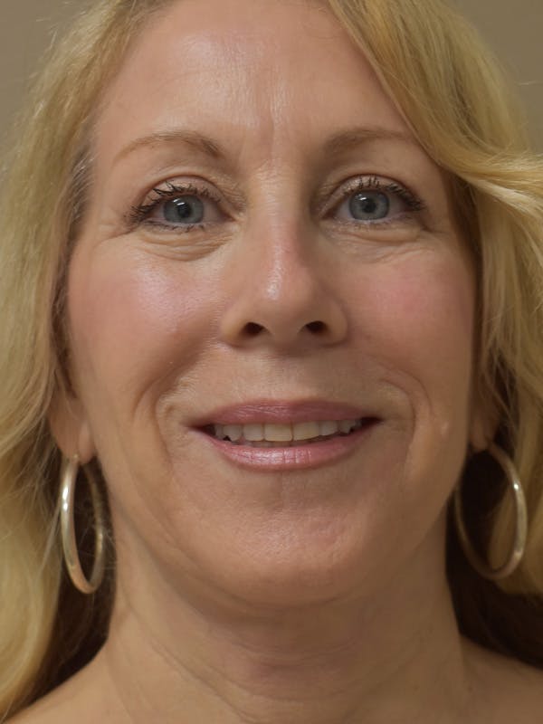 Facelift Before & After Gallery - Patient 342566 - Image 4