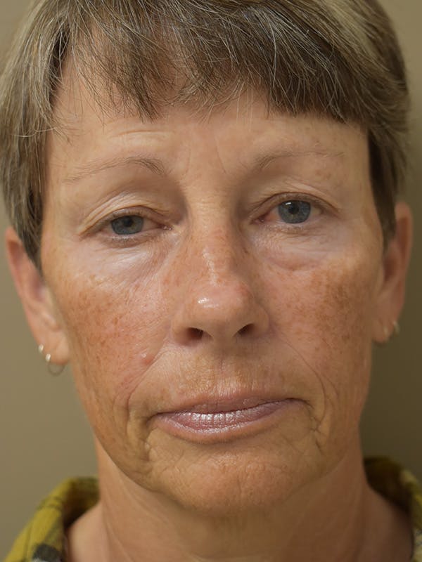 Eyelid Surgery Before & After Gallery - Patient 427734 - Image 3