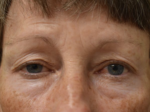 Eyelid Surgery Before & After Gallery - Patient 427734 - Image 1