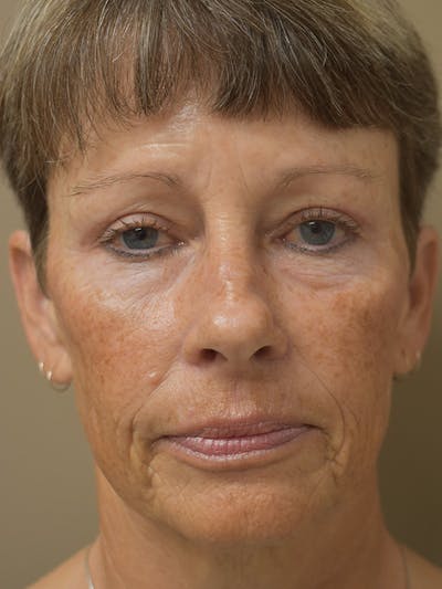 Eyelid Surgery Before & After Gallery - Patient 427734 - Image 4