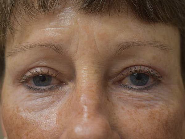 Eyelid Surgery Before & After Gallery - Patient 427734 - Image 2