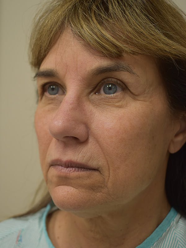 Mini Facelift Before & After Gallery - Patient 290247 - Image 3