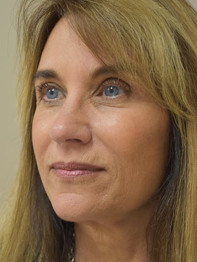 Mini Facelift Before & After Gallery - Patient 290247 - Image 4