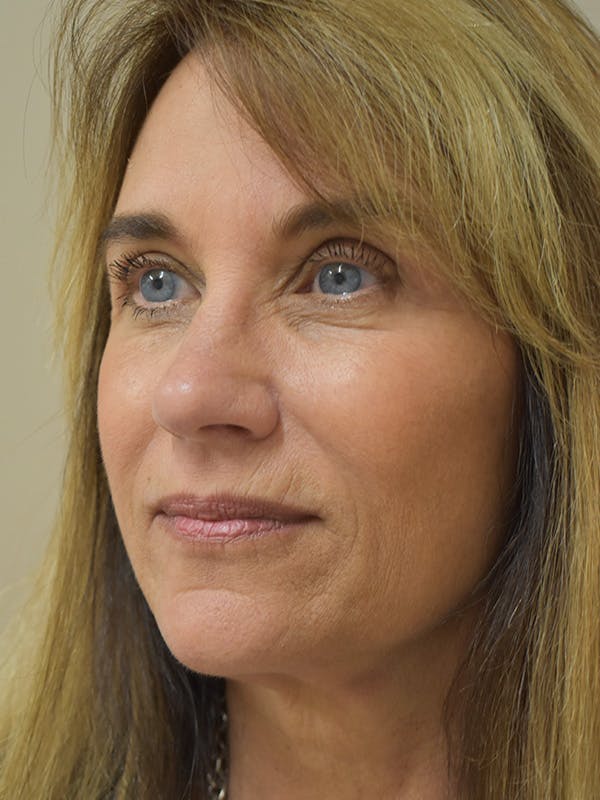 Mini Facelift Before & After Gallery - Patient 290247 - Image 4
