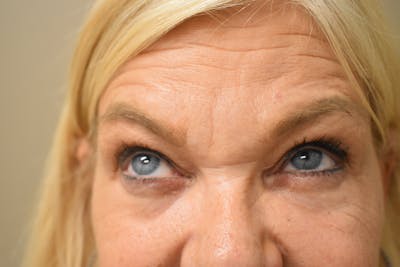Eyelid Surgery Before & After Gallery - Patient 154330 - Image 2