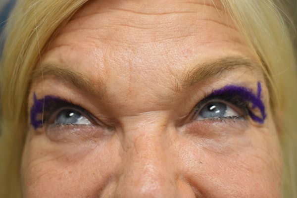 Eyelid Surgery Before & After Gallery - Patient 154330 - Image 1