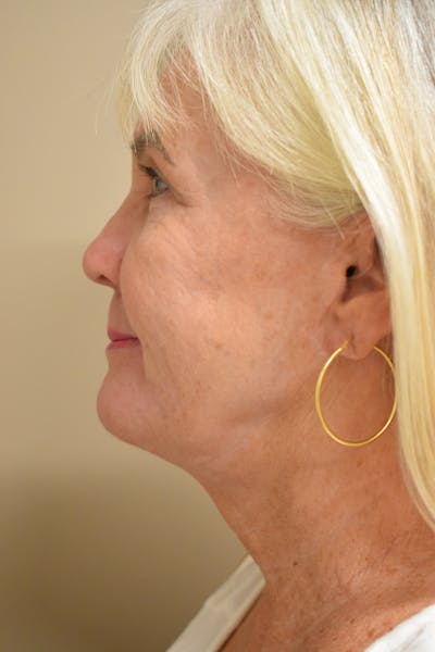 Facelift Before & After Gallery - Patient 236790 - Image 4