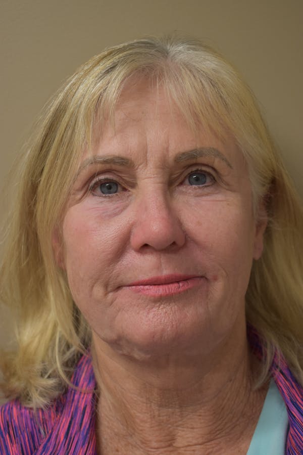 Facelift Before & After Gallery - Patient 236790 - Image 1