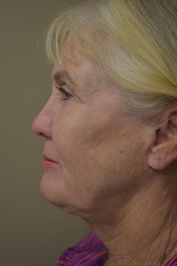 Facelift Before & After Gallery - Patient 236790 - Image 3
