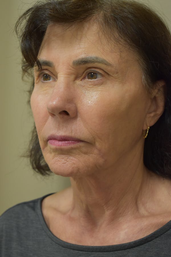 Cheek Lift Before & After Gallery - Patient 334581 - Image 2