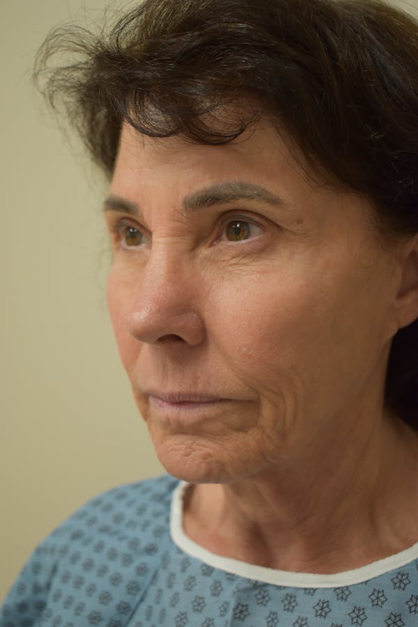 Cheek Lift Before & After Gallery - Patient 334581 - Image 1