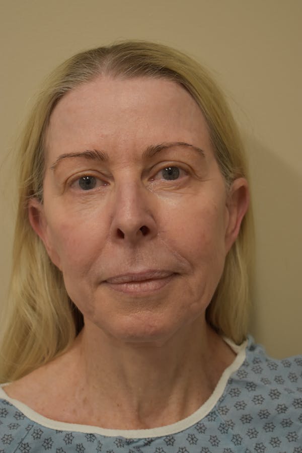 Cheek Lift Before & After Gallery - Patient 285082 - Image 1