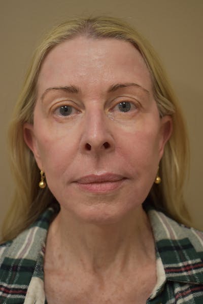 Cheek Lift Before & After Gallery - Patient 285082 - Image 2