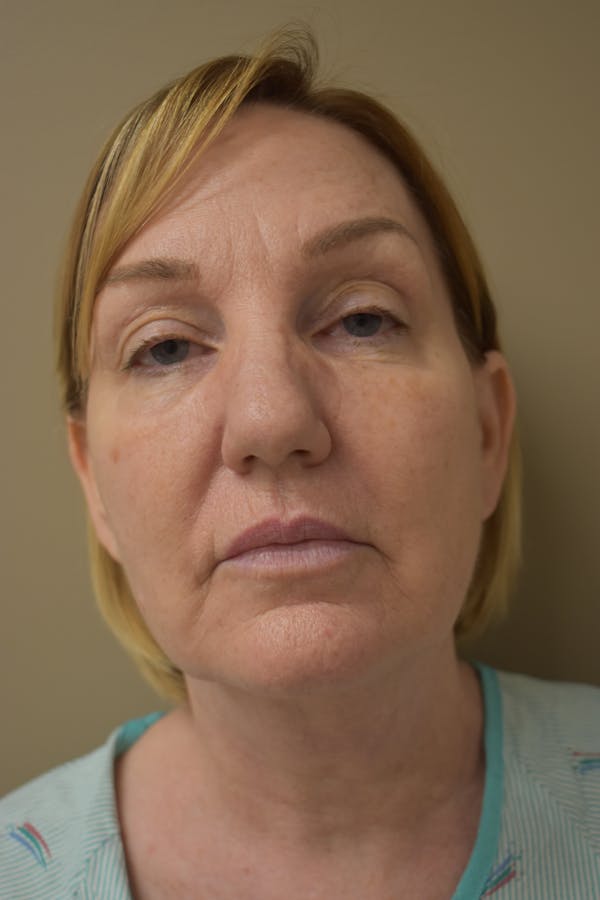 Facelift Before & After Gallery - Patient 229051 - Image 1