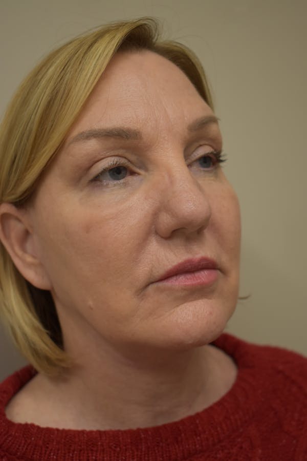 Facelift Before & After Gallery - Patient 229051 - Image 2